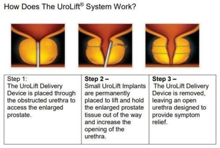 Why did my UroLift not work?
